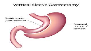 Técnica de Sleeve Gastrectromia Vertical [upl. by Mandell]