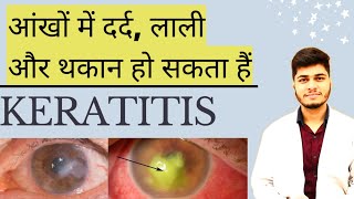 आंखों में दर्द लाली और थकान हो सकता हैं केराटाइटिस । What cause keratitis in eye । Keratitis [upl. by Ynnohj991]