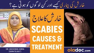 KHARISH KA ILAJ  Scabies Treatment In Urdu  Kharish Ki Bimari Kyun Hoti Hai  Itching Solution [upl. by Navlys152]