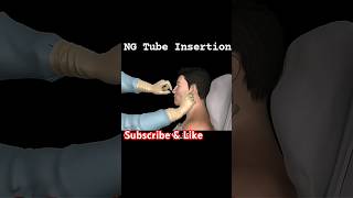 ng tube insertion procedure  ng tube foryou shorts [upl. by Lairret710]