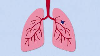 Fibrosis Explained [upl. by Marys61]