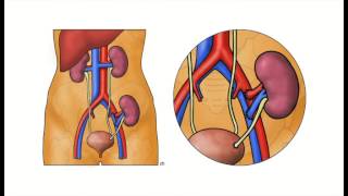 5 Dupuytrens Contracture [upl. by Lorrac]