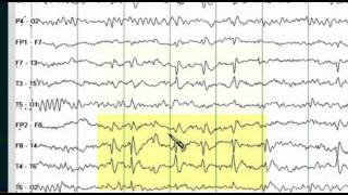 Focal EEG Abnormalities 1 [upl. by Nivlac]