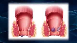 Hurting From Hemorrhoids [upl. by Garibald]