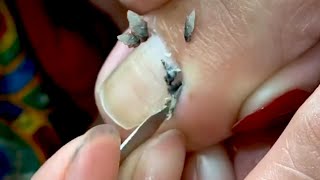 HOW TO CUT THICK TOENAILS  Toenail Cleaning Satisfying 22 [upl. by Ellemaj]