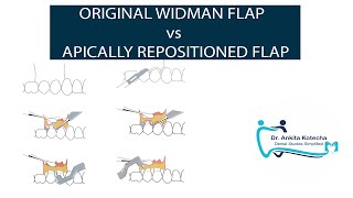 ORIGINAL WIDMAN FLAP vs APICALLY REPOSITIONED FLAP PERIODONTAL FLAP SURGERY DR ANKITA KOTECHA [upl. by Hafeenah]