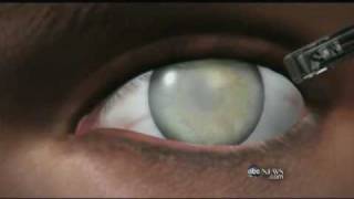 Medical Breakthrough Restoring Sight to the Blind [upl. by Nebeur714]