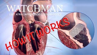 HCA Virginia – WATCHMAN Video 2 Left Atrial Appendage Closure Device [upl. by Hsan]