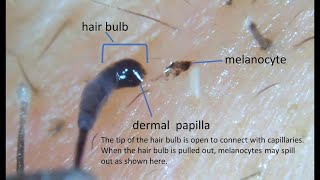 The tip of the hair bulb is open plucking facial hair 021221 [upl. by Ybab141]