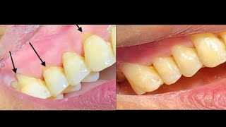 Cervical Abrasion Treatment  Dental  Before and After [upl. by Ynabe292]