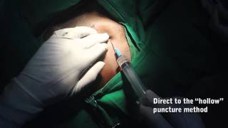 Direct Puncture of Axillary Vein Modified Low Approach [upl. by Devan]