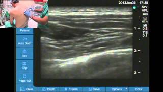 Ultrasound guided thoracic paravertebral space location [upl. by Annig]