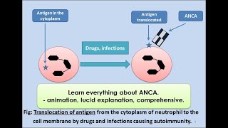 ANCA Anti Neutrophilic Cytoplasmic Antibody pathology vasculitis [upl. by Lerret]