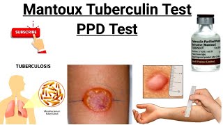 Mantoux Test  Tuberculin Skin Test  PPD Test  Purified protein derivative [upl. by Ocirema]