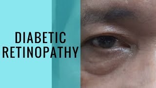 Diabetic Retinopathy Risks Symptoms Prevention and Treatment [upl. by Tanaka]