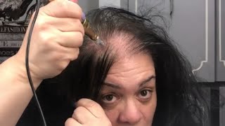 MICRO NEEDLING MY BALD SCALP FOR EXTREME HAIR GROWTH FAST [upl. by Airdnaxila]