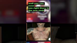 Episode 31 Lichenoid dermatitis scalp psoriasis and inverse psoriasis Part 2 prife testimonial [upl. by Herrle]