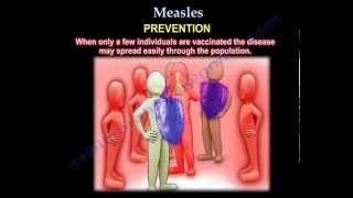 Measles  Everything You Need To Know  Dr Nabil Ebraheim [upl. by Bella118]