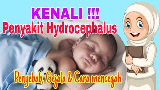 Hidrosefalus Kongenital  Neurologi  Anak  Bedah  Materi Kedokteran [upl. by Nnomae]