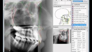 Cephalometric Analysis OnyxCeph³ [upl. by Airun]