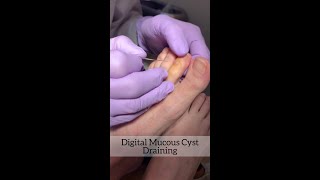 Mucous Cyst Draining [upl. by Sawtelle534]