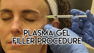 Plasma Gel Filler Procedure [upl. by Lleksah]