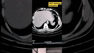 Why cant CT and PET scans find ovarian cancer  Is it true  Dr Praveen Kammar Mumbai [upl. by Alrzc]