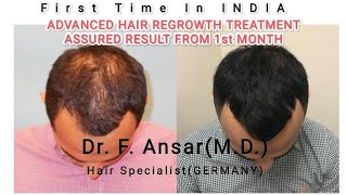 UHSCBy klinik AestheticaNow also in NewDelhiAdvanced hair regrowth treatment hair loss treatment [upl. by Adnahs966]