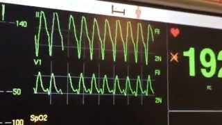 Taquicardia ventricular monomórfica arritmia ventricular [upl. by Liatris811]