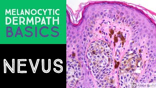 Melanocytic Dermpath Basics Benign Nevus [upl. by Gizela301]