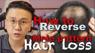 How to Reverse Male Pattern Baldness  Hair Loss in Men [upl. by Christin344]