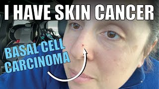 Basal cell carcinoma educational video [upl. by Oiracam]