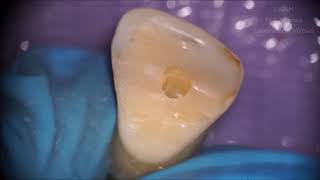 Cavidad de Acceso en Endodoncia en Incisivo Lateral Superior [upl. by Aihtenyc122]