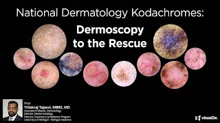 National Dermatology Kodachromes Dermoscopy to the Rescue [upl. by Kassab]