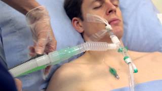 Using Intersurgicals TrachSeal™ closed suction systems [upl. by Sawyere574]