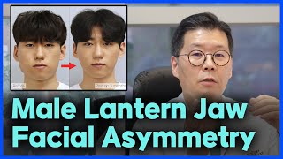 Male Lantern Jaw and Facial Asymmetry Double Jaw Surgery Here’s How It Was Performed [upl. by Nilyram542]