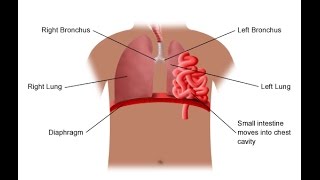 Diaphragmatic Hernia [upl. by Landmeier]