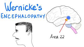 Wernickes Aphasia Fluent Aphasia  Neurology [upl. by Liris]