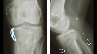 18 HYPERTROPHIC OSTEOARTHROPATHY [upl. by Giulio]