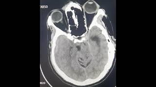 SDH  acuteonchronicsdh  ctscan craniotomy  urgent burr hole or craniotomy [upl. by Yelkao]