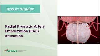 Radial Prostatic Artery Embolization PAE Animation  Terumo Interventional Systems [upl. by Annora]