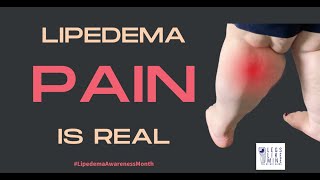 Pain a Major Very Common Symptom of Lipedema [upl. by Benedict]