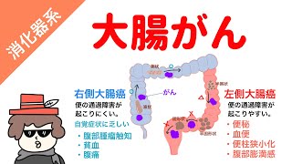 【国試対策用】大腸癌の症状 [upl. by Anirdnaxela250]