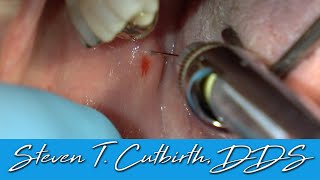 Painless and Profound Mandibular Block  Dental Minute with Steven T Cutbirth DDS [upl. by Bach852]