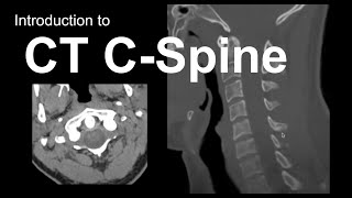 Introduction to CT Cspine Approach and Essentials [upl. by Ssor]