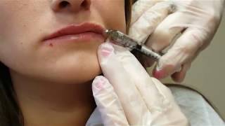 Lip Filler Experience  One Syringe of Juvederm [upl. by Karee]