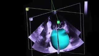 Left Atrial Enlargement [upl. by Donelson]