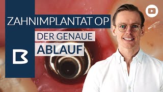 Zahnimplantat OP  Der genaue Ablauf [upl. by Andrews]