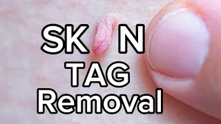 TOP 8 SKIN TAG REMOVAL Removal Methods Commonly Used at HOME [upl. by Calli]