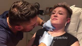 Chin Reduction Procedure using Belkyra [upl. by Pepita]